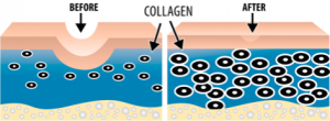 collagen_induction_therapy